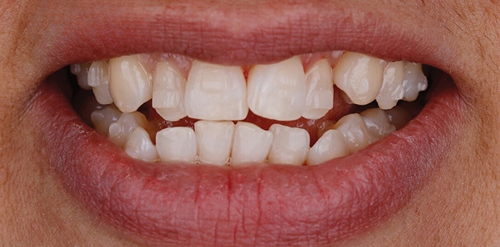 Clínica Cehom antes e depois sorrisso