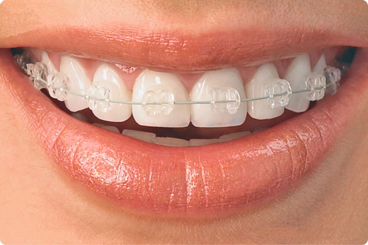 aparelho-estetico-de-safira cehom