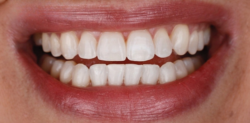 Clínica Cehom antes e depois sorrisso 2