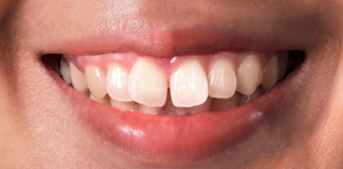 aparelho-ortodontico-antes-e-depois 2