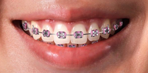 aparelho-ortodontico-antes-e-depois 3